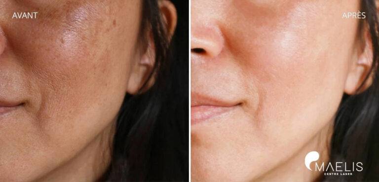 résultat avant après d'une femme ayant réalisée un soin hydrafacial avec une peau plus éclatante