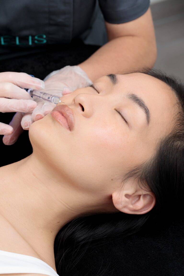 Injection d’acide hyaluronique dans les lèvres réalisée par un professionnel Maelis à Paris